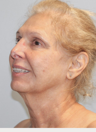 Before Image: Facelift and Neck Lipo-Dr.Howell - left-front-oblique