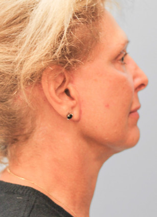 After Image: Facelift and Neck Lipo-Dr.Howell - right-side