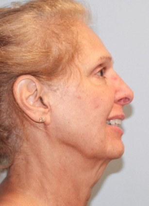 Before Image: Facelift and Neck Lipo-Dr.Howell - right-side