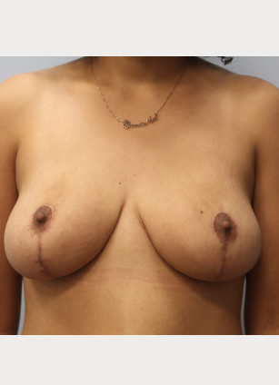 After Image: Breast Reduction-Dr.Howell - front