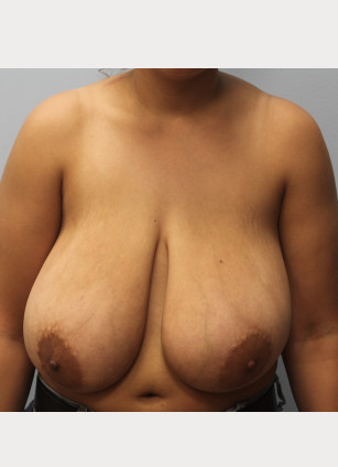 Before Image: Breast Reduction-Dr.Howell - front