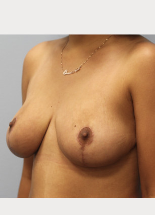 After Image: Breast Reduction-Dr.Howell - left-front-oblique
