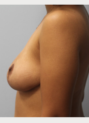 After Image: Breast Reduction-Dr.Howell - left-side