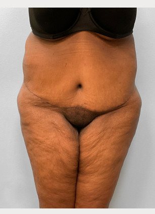 After Image: Body Lift-Dr.Howell - front