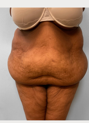 Before Image: Body Lift-Dr.Howell - front
