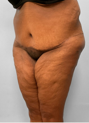 After Image: Body Lift-Dr.Howell - left-front-oblique