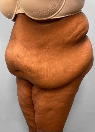 Before Image: Body Lift-Dr.Howell - left-front-oblique