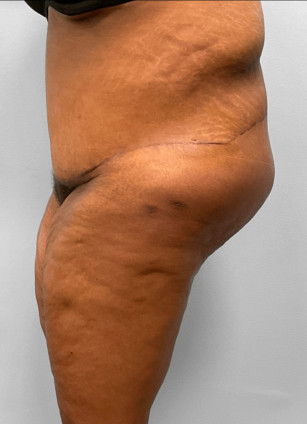 After Image: Body Lift-Dr.Howell - left-side