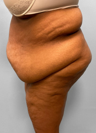 Before Image: Body Lift-Dr.Howell - left-side