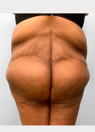 After Image: Body Lift-Dr.Howell - back