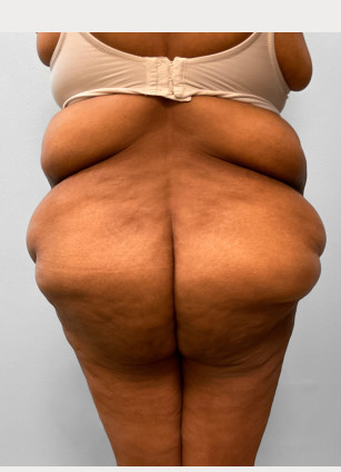 Before Image: Body Lift-Dr.Howell - back