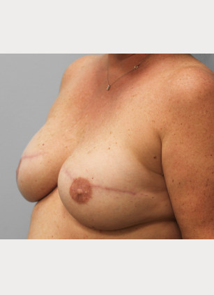 After Image: Breast Reconstruction-Dr.Tucker - left-front-oblique