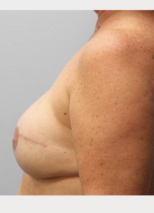 After Image: Breast Reconstruction-Dr.Tucker - left-side