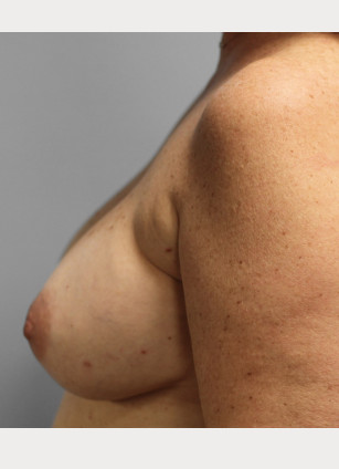 Before Image: Breast Reconstruction-Dr.Tucker - left-side