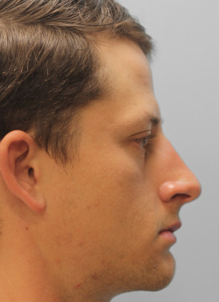 After Image: Rhinoplasty-Dr.Tucker - right-side