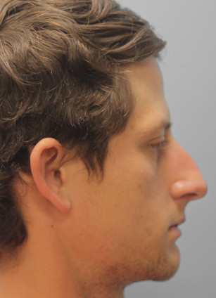 Before Image: Rhinoplasty-Dr.Tucker - right-side