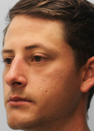 After Image: Rhinoplasty-Dr.Tucker - left-front-oblique