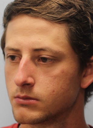 Before Image: Rhinoplasty-Dr.Tucker - left-front-oblique