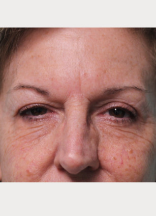After Image: Upper Blepharoplasty-Dr.Tucker - front