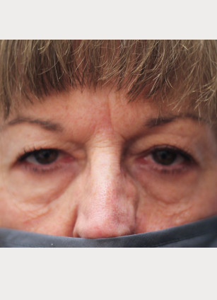 Before Image: Upper Blepharoplasty-Dr.Tucker - front