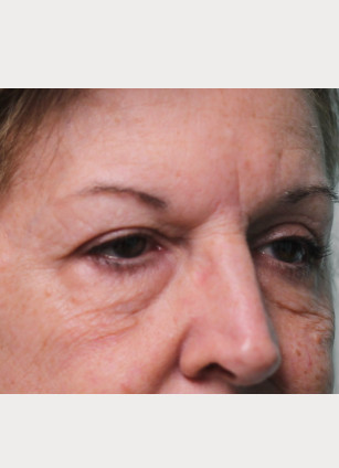 After Image: Upper Blepharoplasty-Dr.Tucker - right-front-oblique