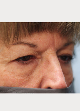 Before Image: Upper Blepharoplasty-Dr.Tucker - right-front-oblique