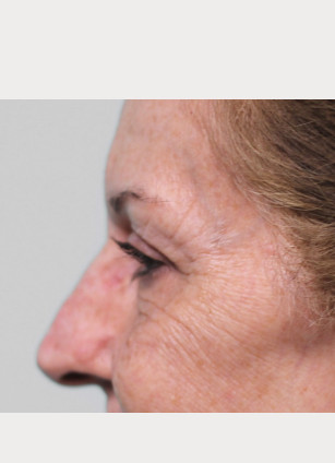 After Image: Upper Blepharoplasty-Dr.Tucker - left-side