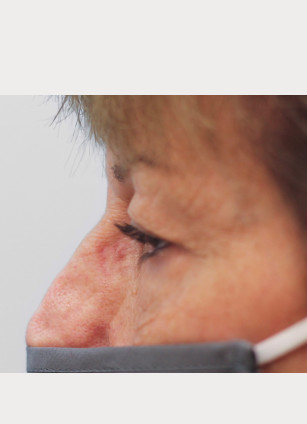 Before Image: Upper Blepharoplasty-Dr.Tucker - left-side