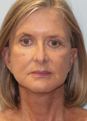After Image: Face & Brow Lift with Blepharoplasty- Dr.Howell - front