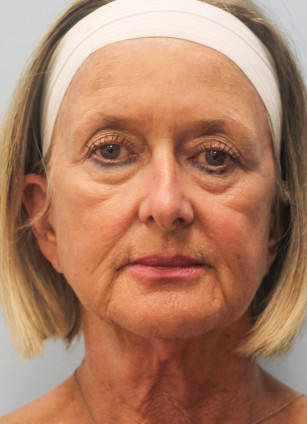 Before Image: Face & Brow Lift with Blepharoplasty- Dr.Howell - front