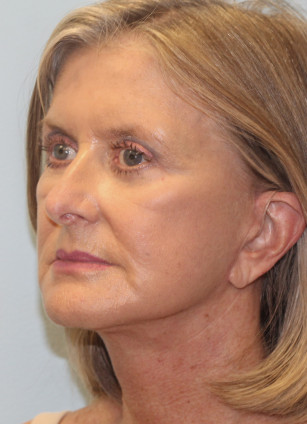 After Image: Face & Brow Lift with Blepharoplasty- Dr.Howell - left-front-oblique