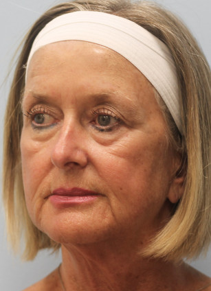 Before Image: Face & Brow Lift with Blepharoplasty- Dr.Howell - left-front-oblique