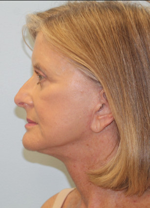 After Image: Face & Brow Lift with Blepharoplasty- Dr.Howell - left-side