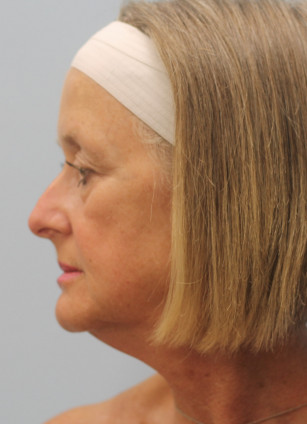 Before Image: Face & Brow Lift with Blepharoplasty- Dr.Howell - left-side