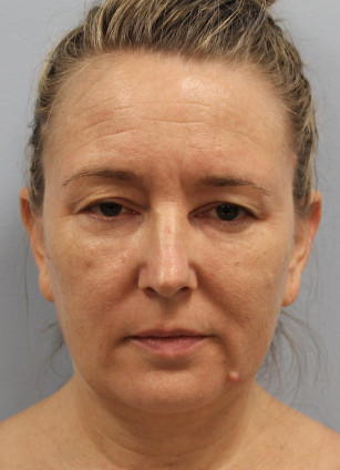 Before Image: Upper Bleph, Browlift, and Submental Smart Lipo- Dr.Howell - front