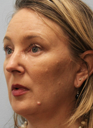 After Image: Upper Bleph, Browlift, and Submental Smart Lipo- Dr.Howell - left-front-oblique