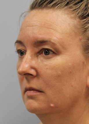 Before Image: Upper Bleph, Browlift, and Submental Smart Lipo- Dr.Howell - left-front-oblique