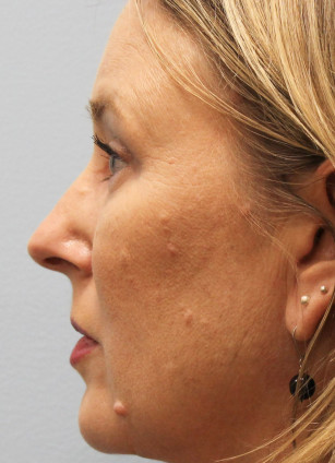After Image: Upper Bleph, Browlift, and Submental Smart Lipo- Dr.Howell - left-side
