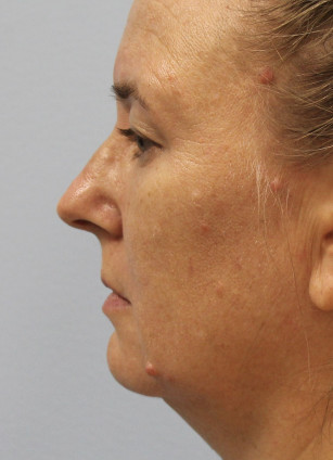 Before Image: Upper Bleph, Browlift, and Submental Smart Lipo- Dr.Howell - left-side