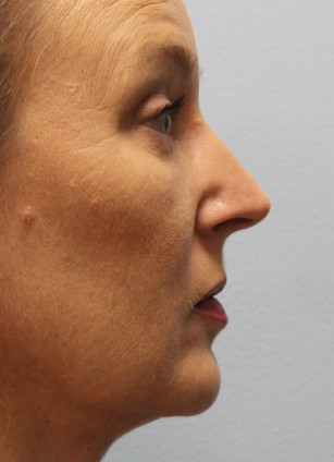 After Image: Upper Bleph, Browlift, and Submental Smart Lipo- Dr.Howell - right-side