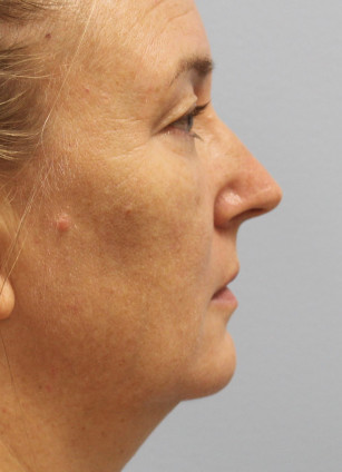 Before Image: Upper Bleph, Browlift, and Submental Smart Lipo- Dr.Howell - right-side
