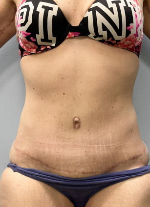 After Image: Abdominoplasty & Lipo- Dr.Howell - front