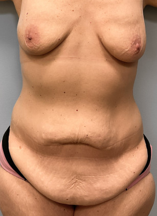 Before Image: Abdominoplasty & Lipo- Dr.Howell - front