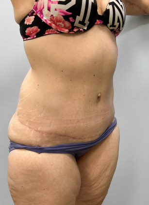 After Image: Abdominoplasty & Lipo- Dr.Howell - other
