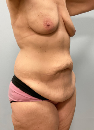 Before Image: Abdominoplasty & Lipo- Dr.Howell - other