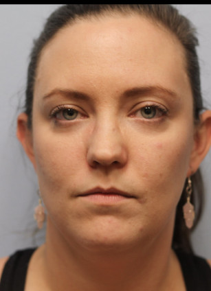 Before Image: Kybella- Dr.Howell - front