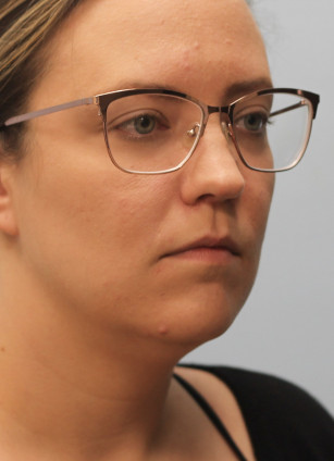 After Image: Kybella- Dr.Howell - right-front-oblique