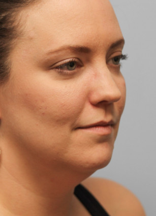 Before Image: Kybella- Dr.Howell - right-front-oblique