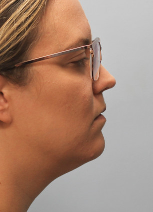 After Image: Kybella- Dr.Howell - right-side