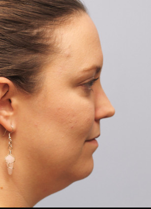 Before Image: Kybella- Dr.Howell - right-side